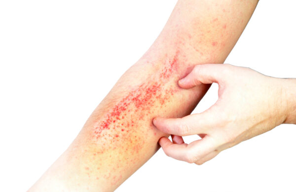 Itch-Eze 100ml - Image 3